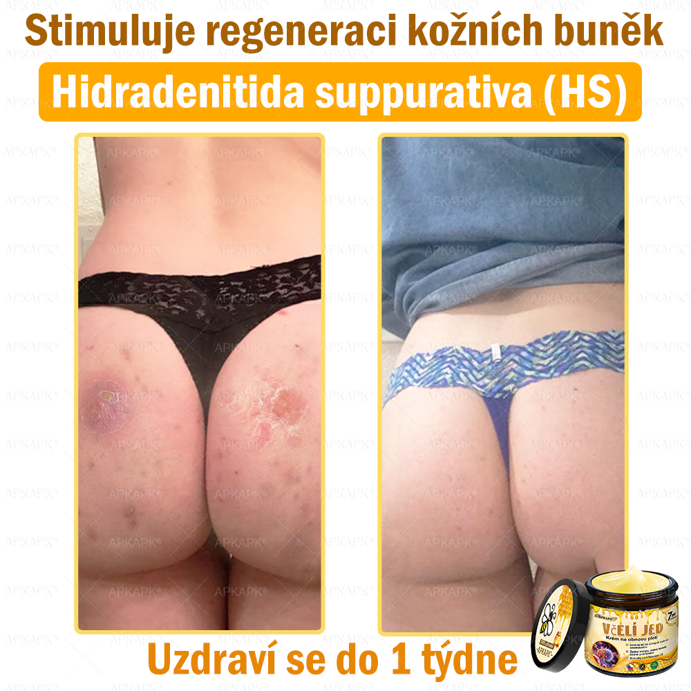 Dermatologicky a klinicky testováno👩‍⚕️🎁APKAPK®Bee Venom Krém na obnovení pleti🐝 pomáhá při léčbě kožních problémů, jako jsou: vrásky, jizvy, pigmentové skvrny, strie, akné, psoriáza, ekzém, kožní změny, podráždění, záněty a další kožní problémy.