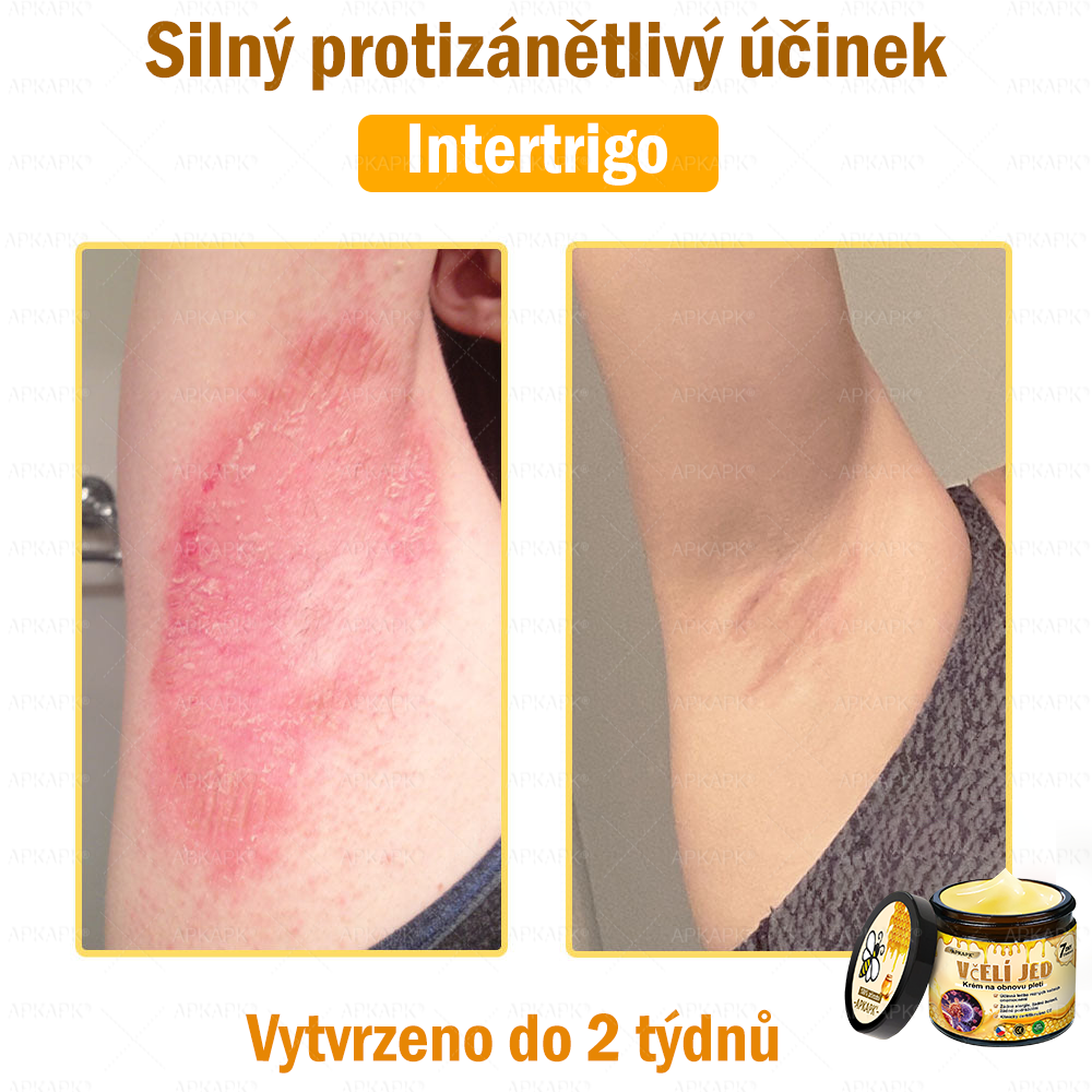 Dermatologicky a klinicky testováno👩‍⚕️🎁APKAPK®Bee Venom Krém na obnovení pleti🐝 pomáhá při léčbě kožních problémů, jako jsou: vrásky, jizvy, pigmentové skvrny, strie, akné, psoriáza, ekzém, kožní změny, podráždění, záněty a další kožní problémy.