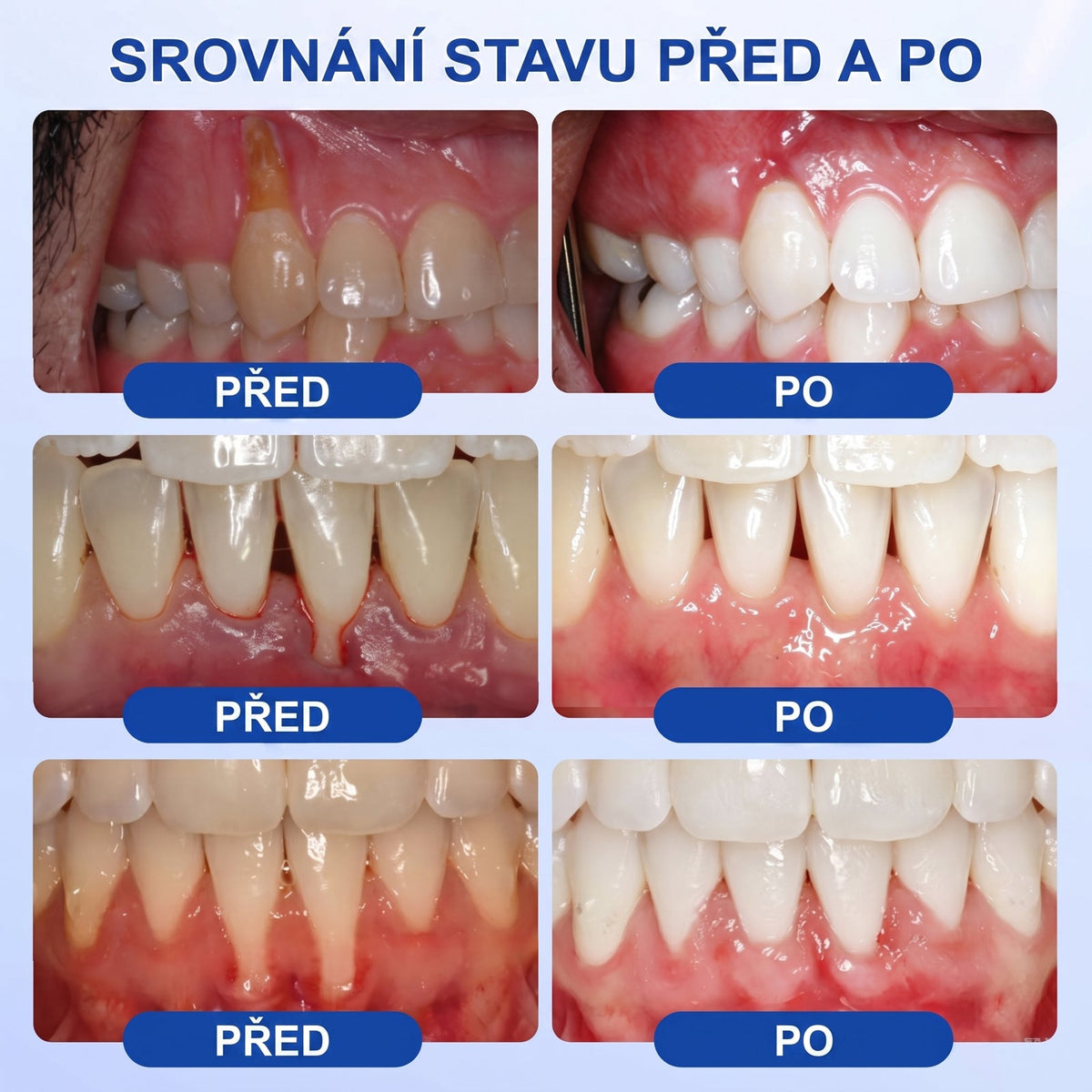 💖PureShade® 🦷 GumRevive regenerační gel na dásně – pro zdravější dásně a sebevědomější úsměv 👍
