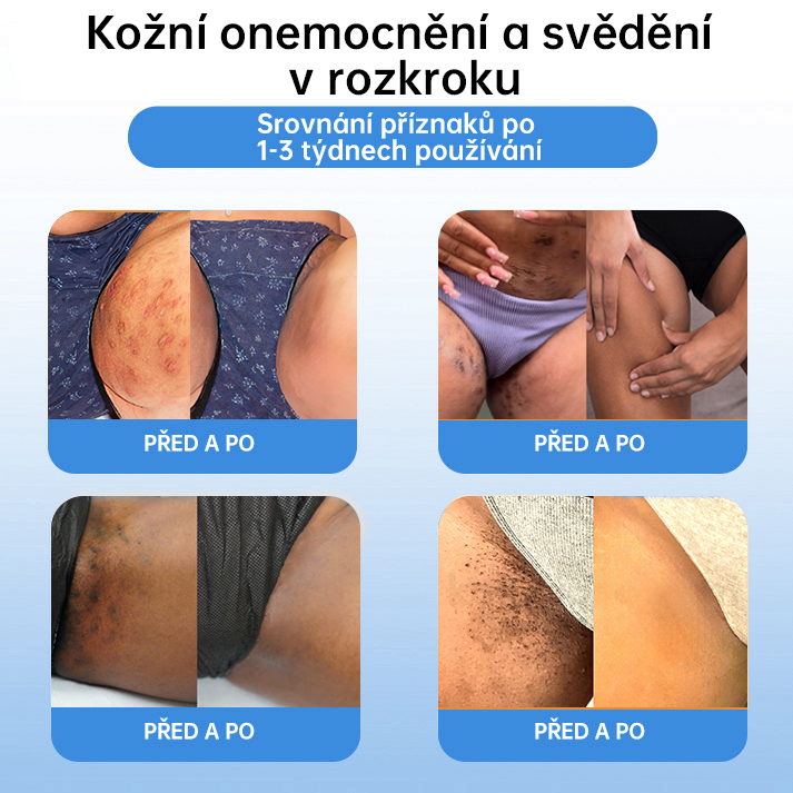 FFBSI® CoolErase Sprej pro regeneraci pokožky (Bradavice, Puchýře, Ekzém, Lupy, Kožní keratózy, Akné, Kožní výrůstky, Jizvy, Mateřská znaménka)