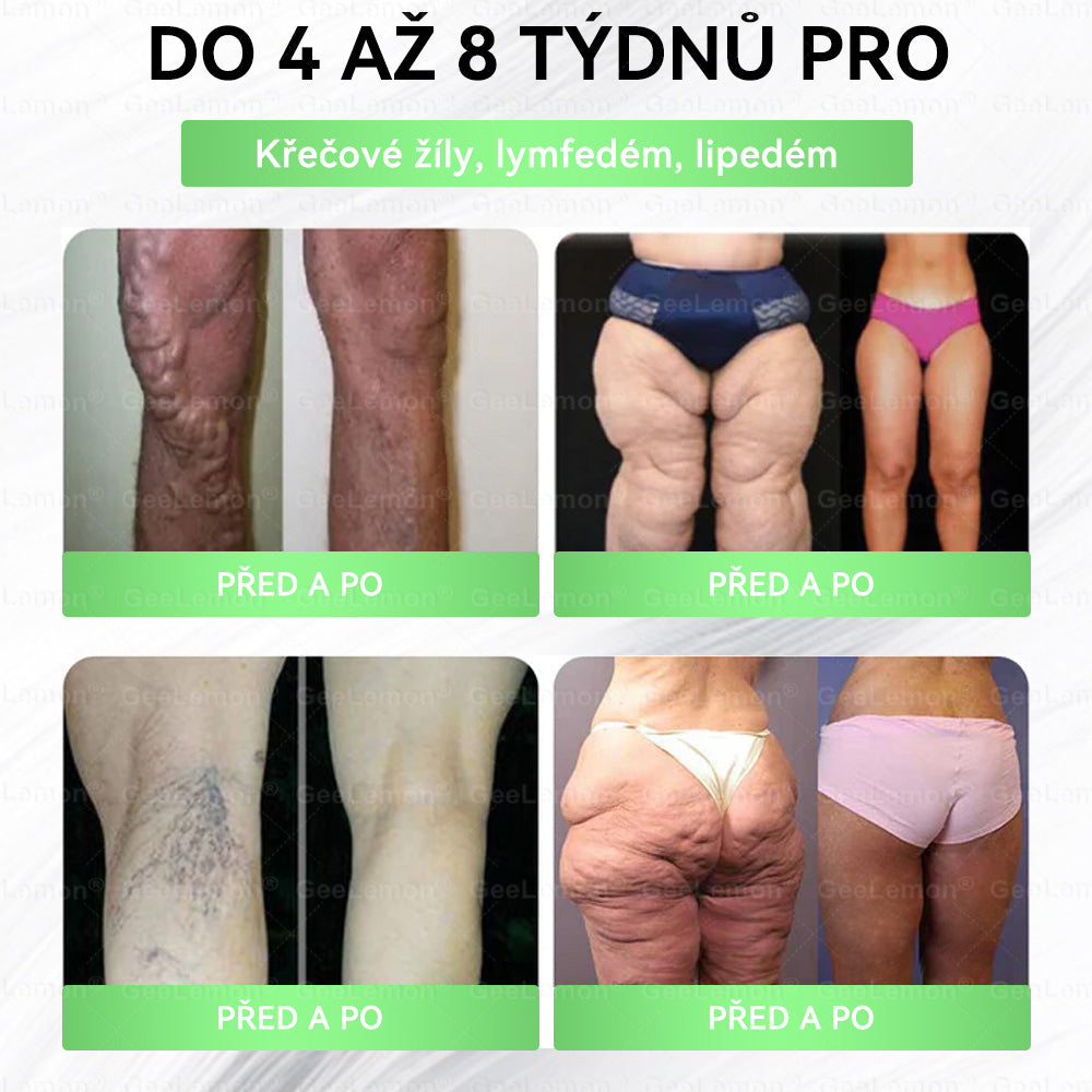 𝐆𝐞𝑒𝑙𝑒𝐦𝐨𝐧® 🥂 Glum𝐚𝐬𝐞tide 15 v 1 – Zeštíhlující nano mikrojihlový náplas(Pouze jednou denně, viditelné změny již za 7 dní)  Určeno pro osoby s obezitou, diabetem, spánkovou apnoe
