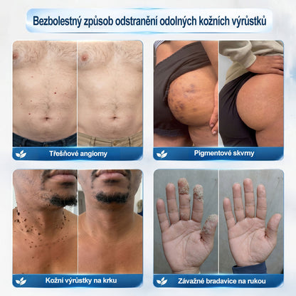 Oficiální značkový obchod | 💚Hiskin® 7denní odstraňovač skvrn a pigmentových skvrn (Bezbolestný rollerball bez jizev)🐬