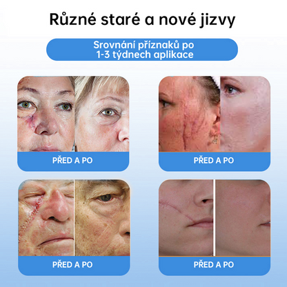 FFBSI® CoolErase Sprej pro regeneraci pokožky (Bradavice, Puchýře, Ekzém, Lupy, Kožní keratózy, Akné, Kožní výrůstky, Jizvy, Mateřská znaménka)