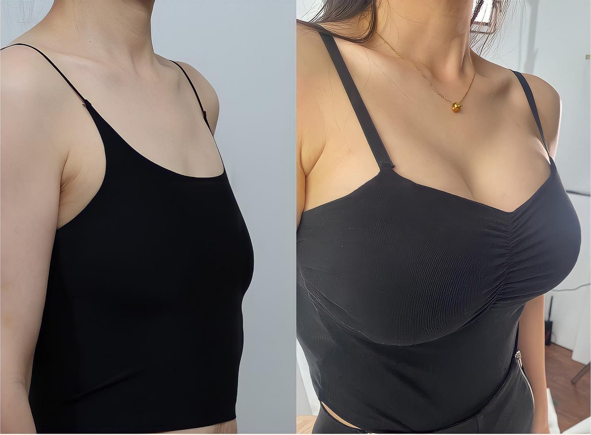 💯HISKIN® Mikroneedlová náplast pro podporu objemu, lifting a pevnost prsou