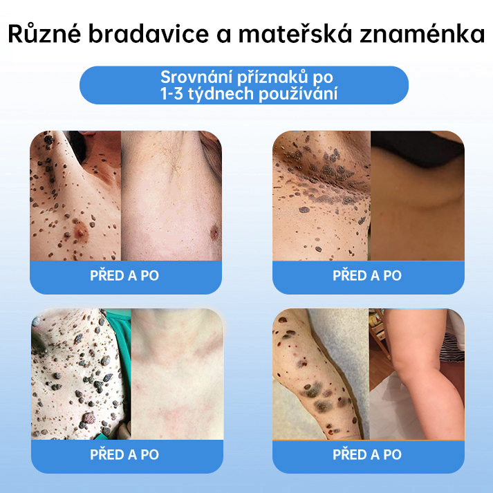 FFBSI® CoolErase Sprej pro regeneraci pokožky (Bradavice, Puchýře, Ekzém, Lupy, Kožní keratózy, Akné, Kožní výrůstky, Jizvy, Mateřská znaménka)