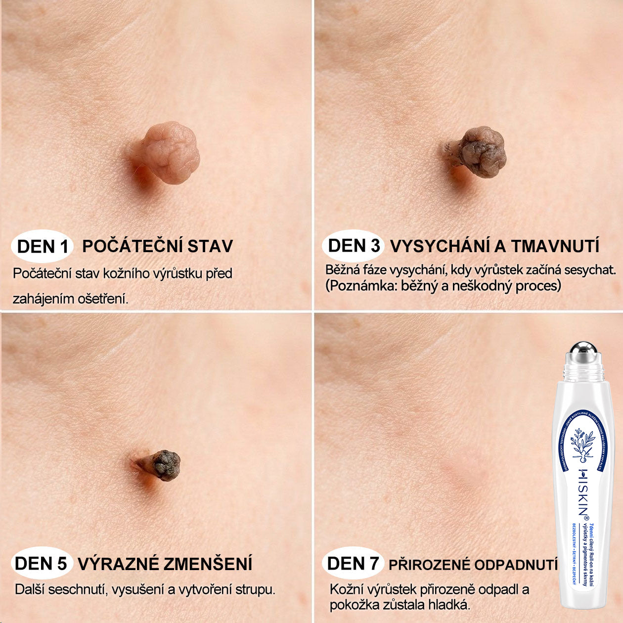 Oficiální značkový obchod | 💚Hiskin® 7denní odstraňovač skvrn a pigmentových skvrn (Bezbolestný rollerball bez jizev)🐬