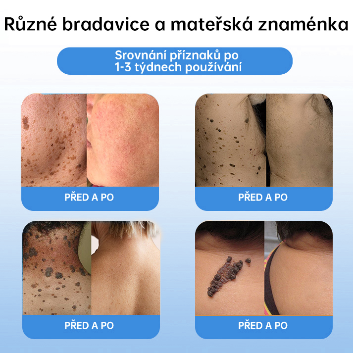 FFBSI® CoolErase Sprej pro regeneraci pokožky (Bradavice, Puchýře, Ekzém, Lupy, Kožní keratózy, Akné, Kožní výrůstky, Jizvy, Mateřská znaménka)