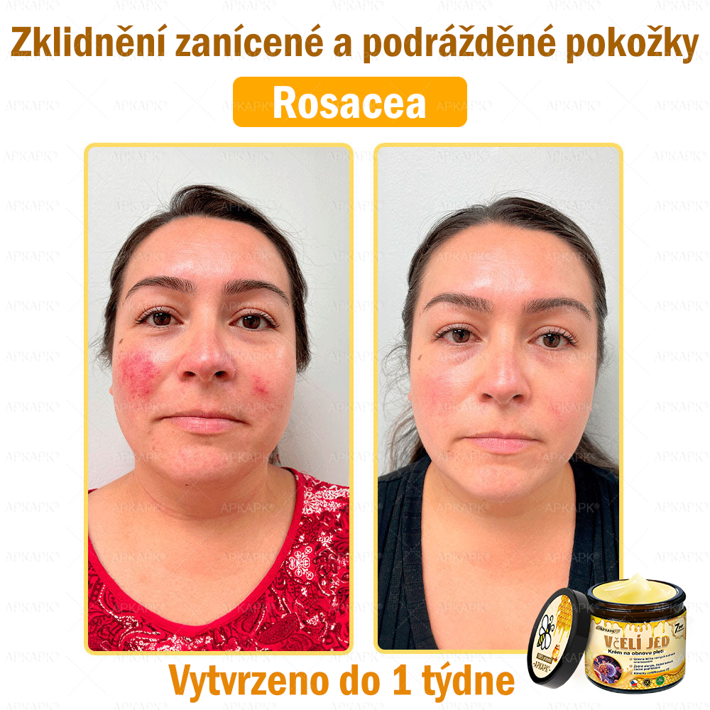 Dermatologicky a klinicky testováno👩‍⚕️🎁APKAPK®Bee Venom Krém na obnovení pleti🐝 pomáhá při léčbě kožních problémů, jako jsou: vrásky, jizvy, pigmentové skvrny, strie, akné, psoriáza, ekzém, kožní změny, podráždění, záněty a další kožní problémy.