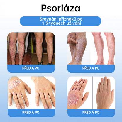 FFBSI® CoolErase Sprej pro regeneraci pokožky (Bradavice, Puchýře, Ekzém, Lupy, Kožní keratózy, Akné, Kožní výrůstky, Jizvy, Mateřská znaménka)