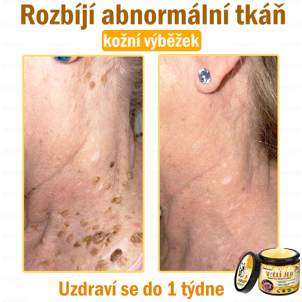 Dermatologicky a klinicky testováno👩‍⚕️🎁APKAPK®Bee Venom Krém na obnovení pleti🐝 pomáhá při léčbě kožních problémů, jako jsou: vrásky, jizvy, pigmentové skvrny, strie, akné, psoriáza, ekzém, kožní změny, podráždění, záněty a další kožní problémy.