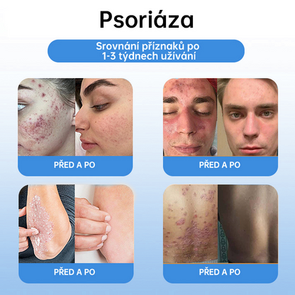 FFBSI® CoolErase Sprej pro regeneraci pokožky (Bradavice, Puchýře, Ekzém, Lupy, Kožní keratózy, Akné, Kožní výrůstky, Jizvy, Mateřská znaménka)