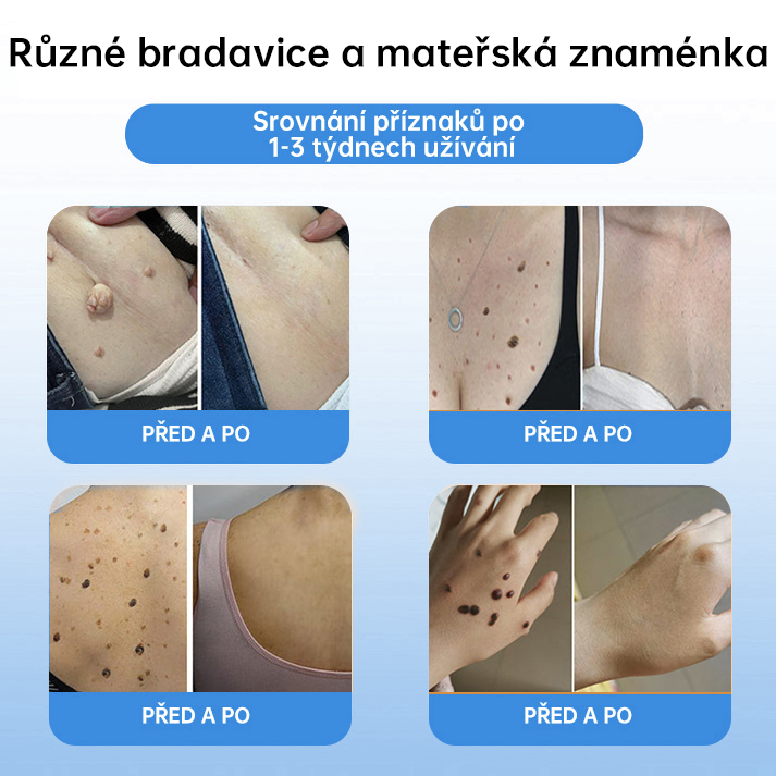 FFBSI® CoolErase Sprej pro regeneraci pokožky (Bradavice, Puchýře, Ekzém, Lupy, Kožní keratózy, Akné, Kožní výrůstky, Jizvy, Mateřská znaménka)