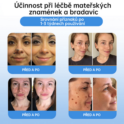 FFBSI® CoolErase Sprej pro regeneraci pokožky (Bradavice, Puchýře, Ekzém, Lupy, Kožní keratózy, Akné, Kožní výrůstky, Jizvy, Mateřská znaménka)