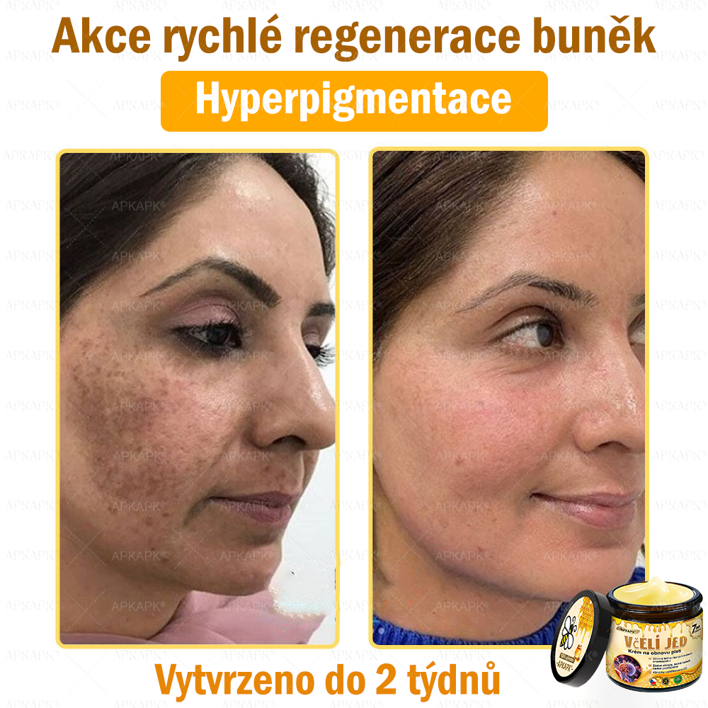 Dermatologicky a klinicky testováno👩‍⚕️🎁APKAPK®Bee Venom Krém na obnovení pleti🐝 pomáhá při léčbě kožních problémů, jako jsou: vrásky, jizvy, pigmentové skvrny, strie, akné, psoriáza, ekzém, kožní změny, podráždění, záněty a další kožní problémy.